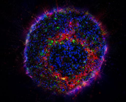 Neuroblastom Organoid (Minitumor)